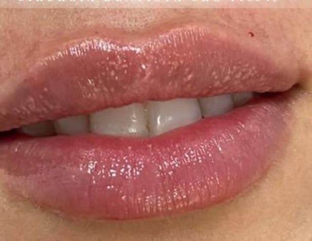 Depois da harmonização labial