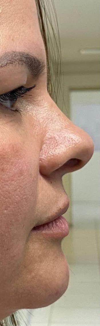 Antes da perfiloplastia