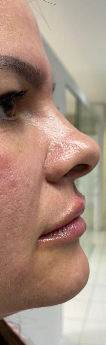 Depois da perfiloplastia