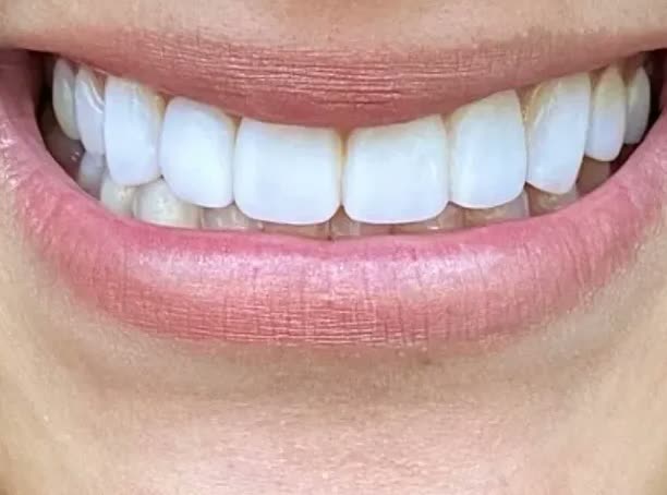 Depois das lentes de porcelana