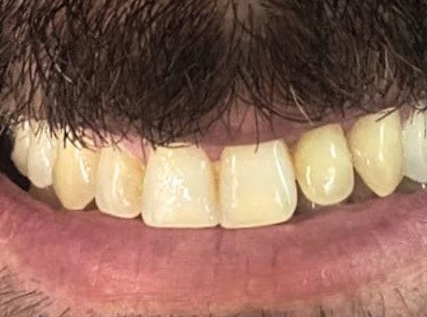 Antes do tratamento estético do sorriso