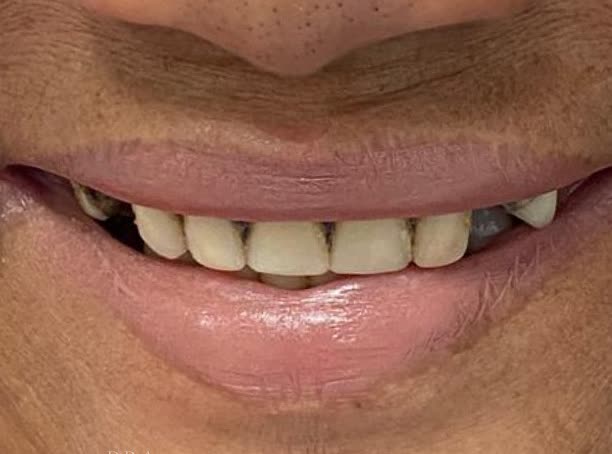 Antes das lentes de porcelana