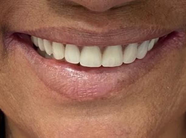 Depois das lentes de porcelana